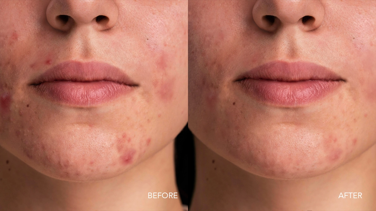 Female chin and lower face with blemishes and breakouts before and after FAQ 502 